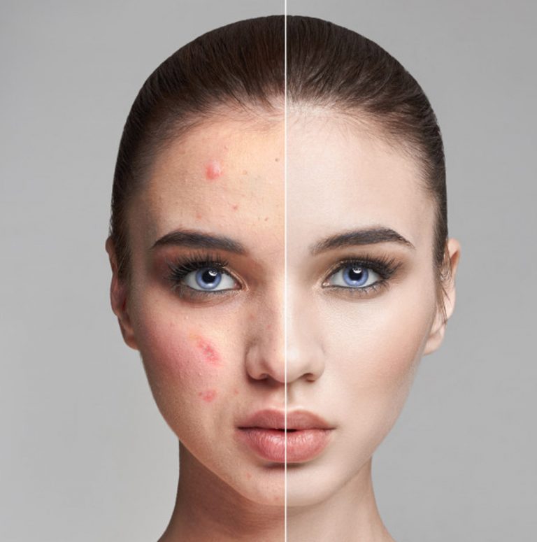 ACNE-ACNESCARS