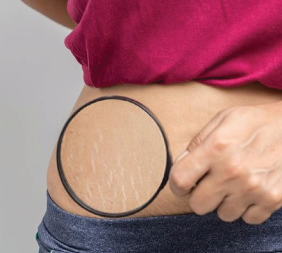 WHAT ARE THE TREATMENTS FOR STRETCH MARKS ?